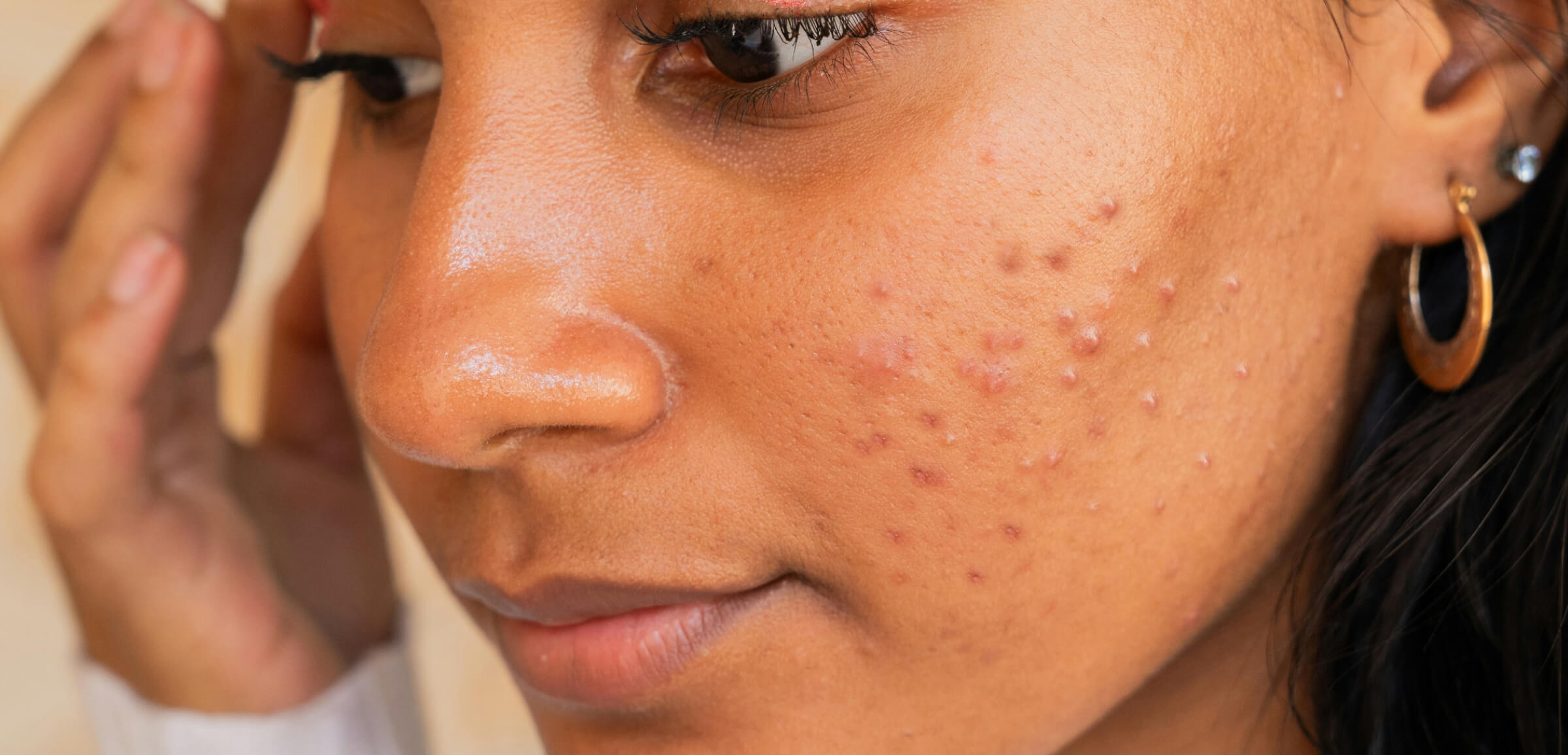 acne removal before