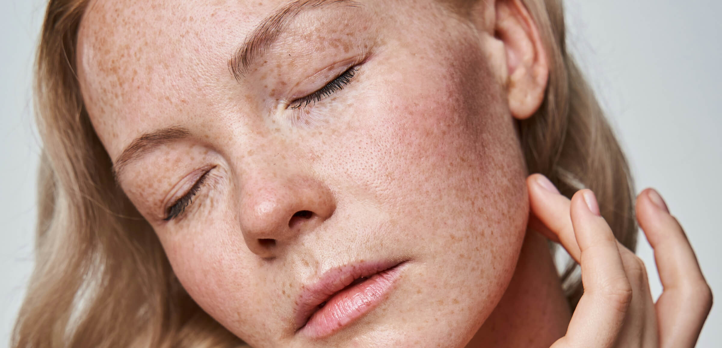 freckles removal before
