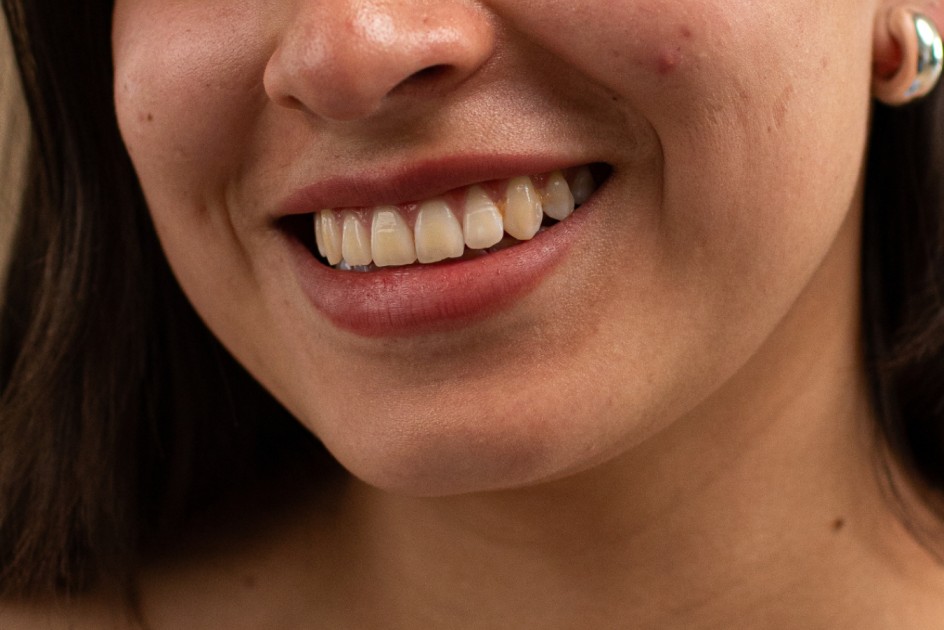 TEETH before
