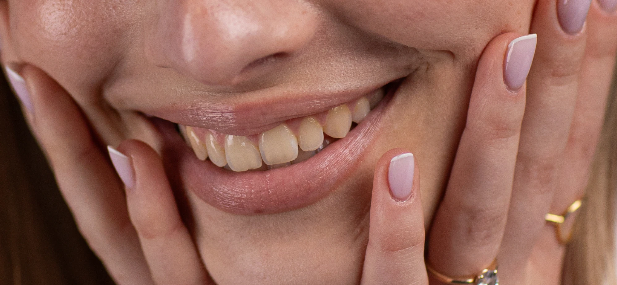 Teeth-Whitening-and-Brightening-before
